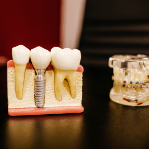 Lohnt sich eine Zahnzusatzversicherung